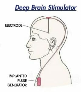deep-brain-stimulator