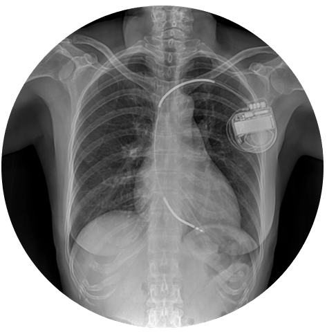 medical device showing up in chest x ray